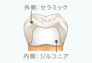 ジルコニアセラミッククラウン