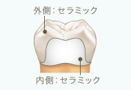 オールセラミッククラウン（e-max レイヤリング）