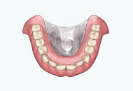 金属床義歯（チタン）