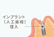 インプラント埋入手術