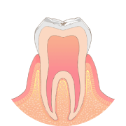 歯の表面に小さなむし歯ができます