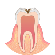 むし歯が神経に近くなると、冷たいものがしみます