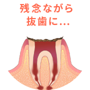 神経が死んでしまうと、痛みを感じなくなります