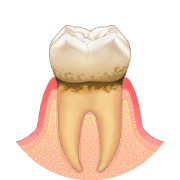 歯茎の縁をはじめ歯の周りの組織に炎症が起きる
