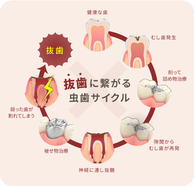 抜歯に繋がる虫歯サイクル