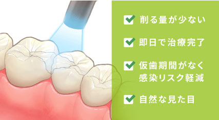 削る量が少ない 削る量が少ない 仮歯期間がなく感染リスク軽減 自然な見た目