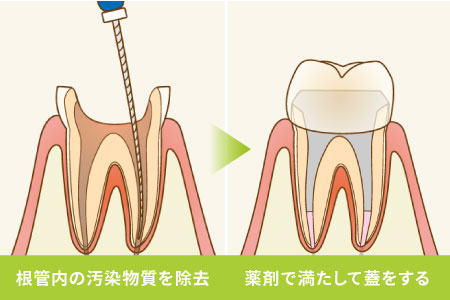 根管内の汚染物質を除去 根管内の汚染物質を除去