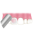 歯の表面をツルツルに仕上げ磨き