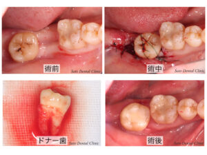 失った歯を補う方法_自家歯牙移植という選択肢 | さとう歯科クリニック 
