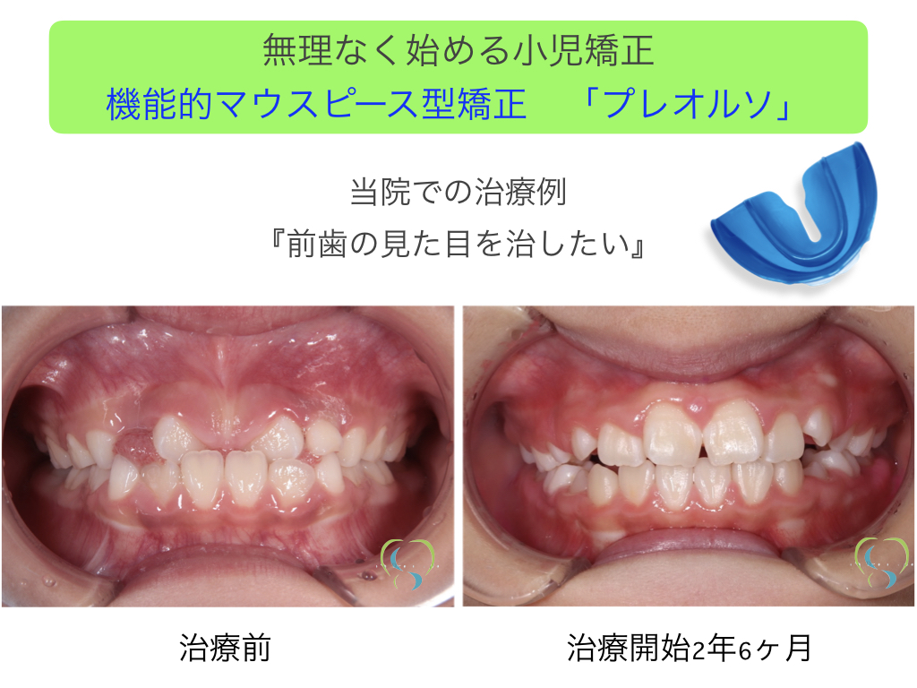 無理なく始める子どもの矯正治療：プレオルソ | さとう歯科クリニック ...